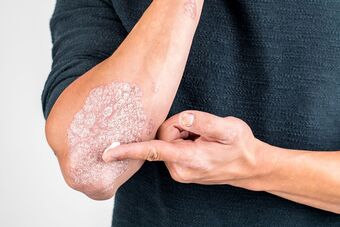 Aplicar o creme na área da pele danificada pela psoríase