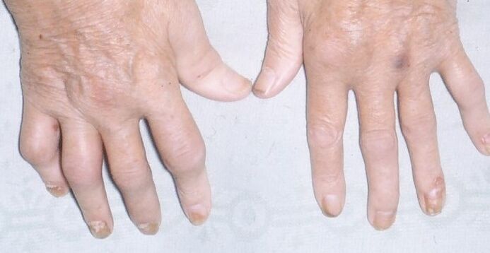 psoríase artropática nas mãos