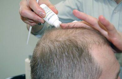tratamento para psoríase do couro cabeludo