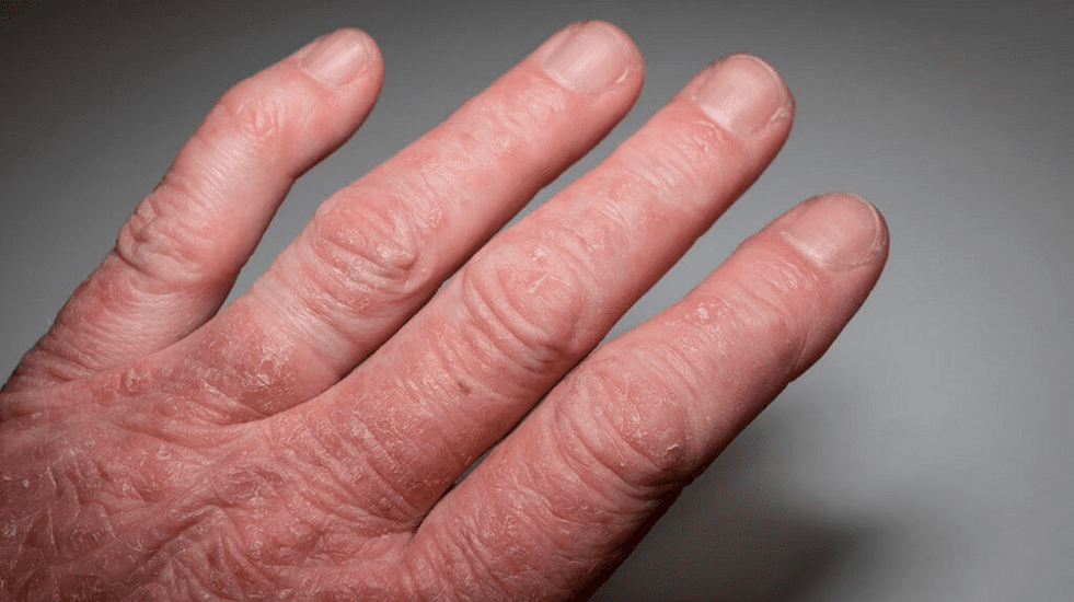 artrite psoriática nas mãos
