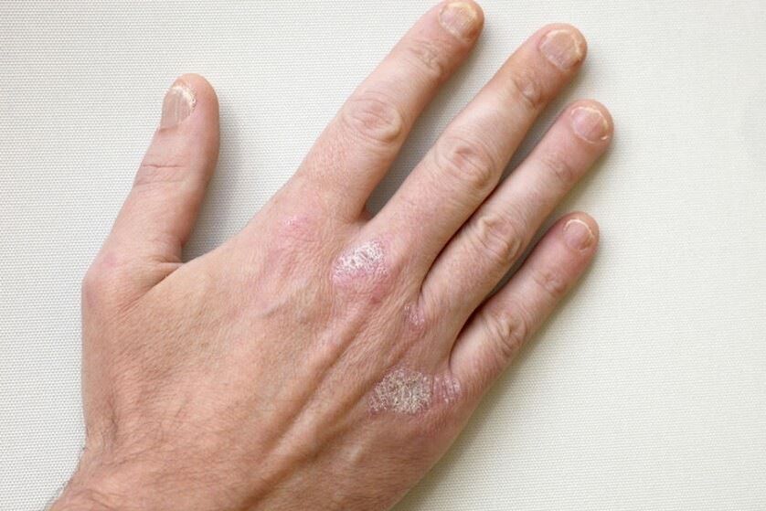 Um sintoma obrigatório da psoríase são placas com escamas na pele