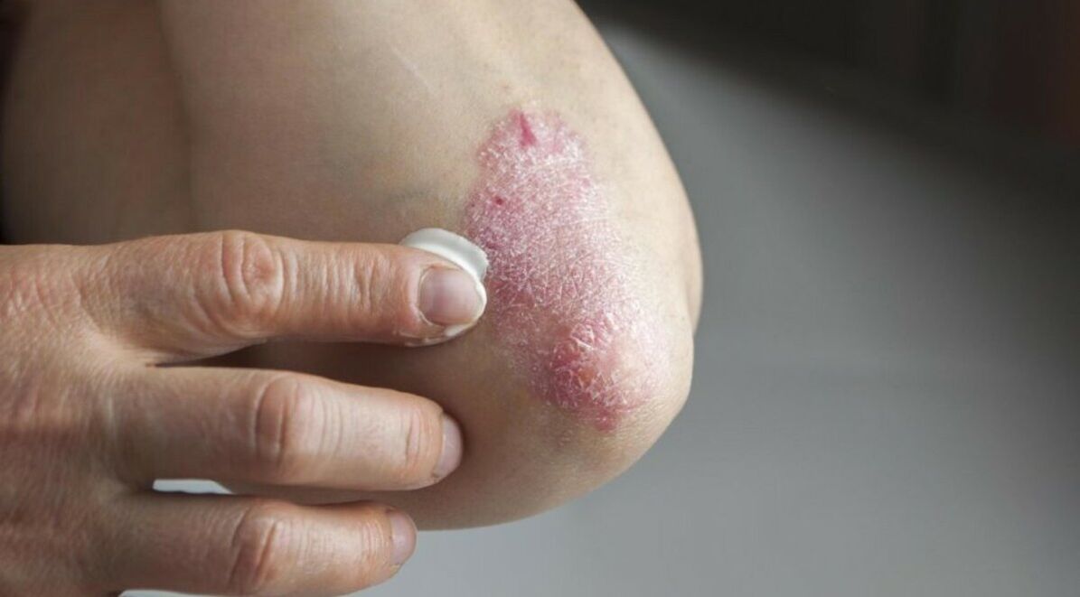 Psoríase que afeta a pele, cujo tratamento inclui o uso de pomadas
