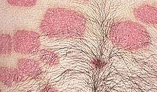 Múltiplas formações rosa no abdômen