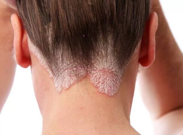 Eritroderma psoriática