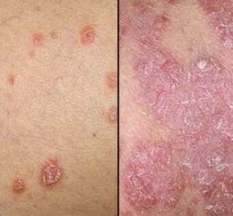 Placas psoriáticas