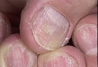 Psoríase de unhas