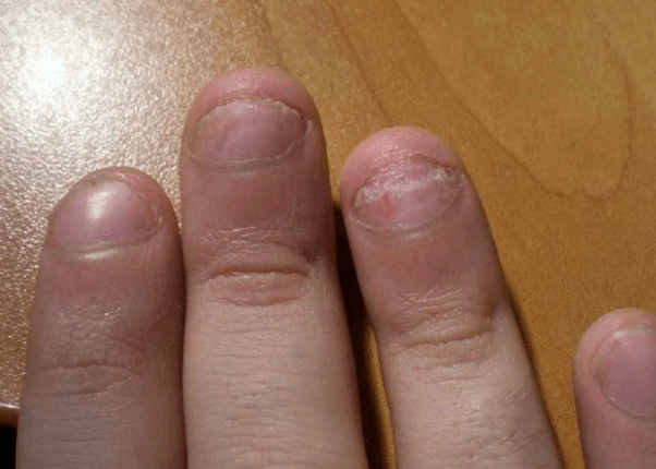 Psoríase de unhas