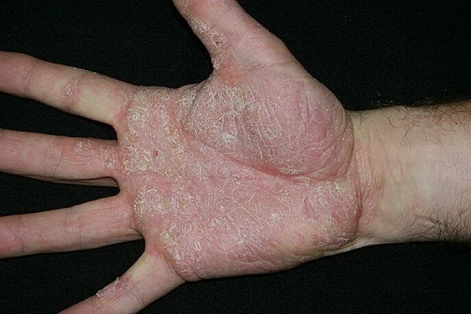 psoríase das palmas das mãos e pés